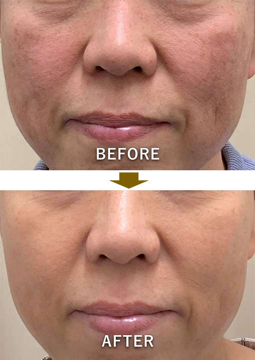 症例1：両頬の色素沈着のイメージ