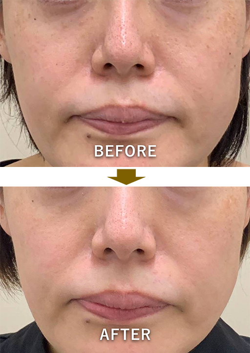 症例2：両頬の色素沈着のイメージ