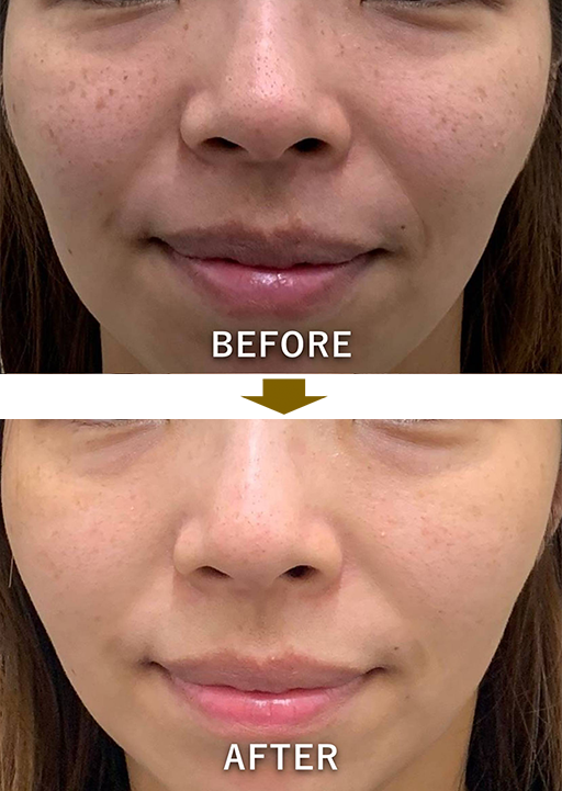 症例3：シミ、そばかす（毛穴・たるみも少し気になる）のイメージ