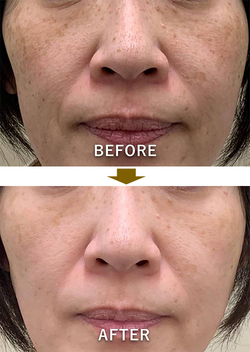 症例4：シミ、両頬の色素斑のイメージ