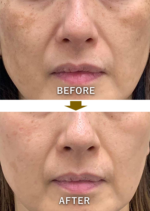 症例5：肝斑のような色素沈着のイメージ